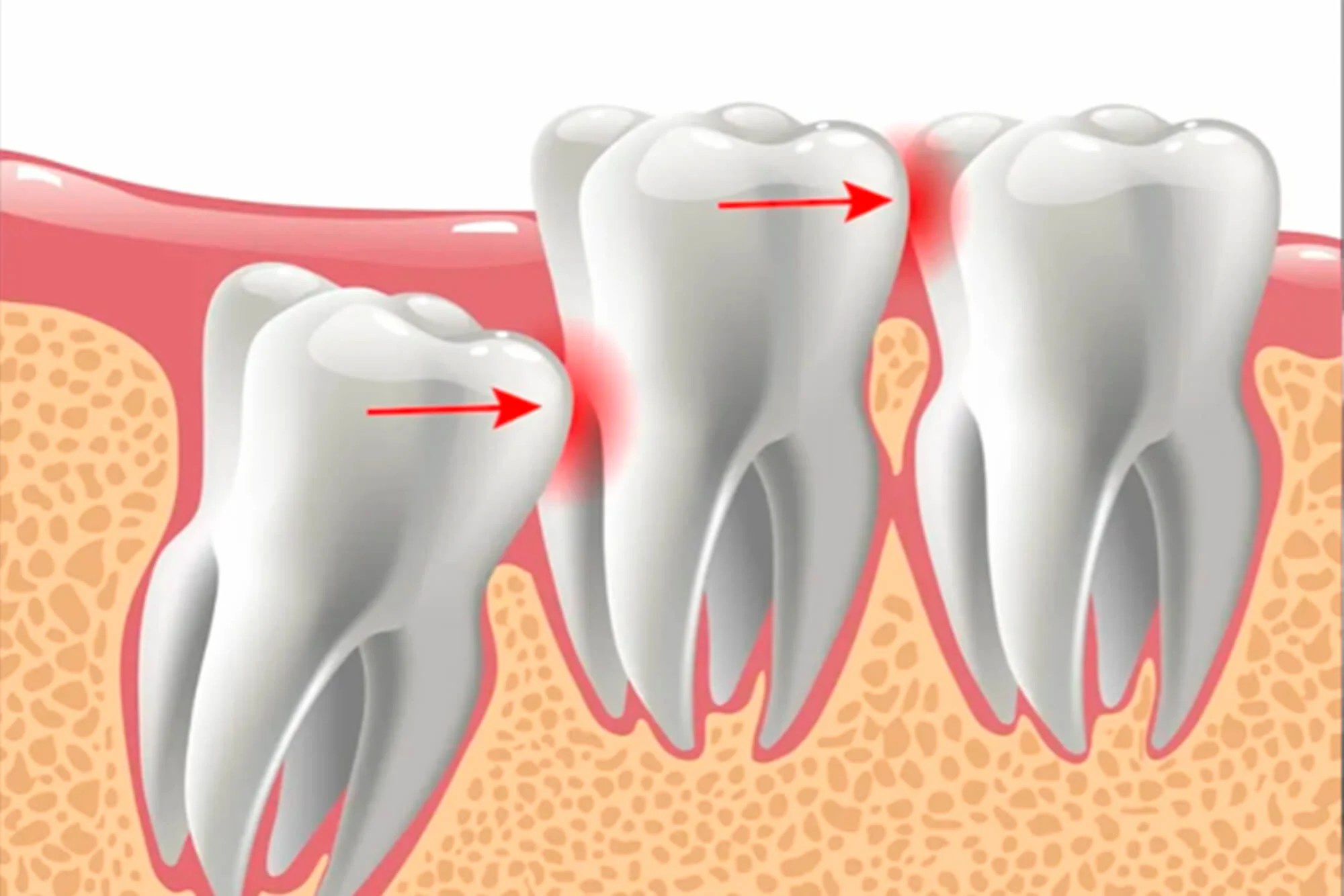 Radiographie panoramique montrant une dent de sagesse qui pousse au fond de la mâchoire