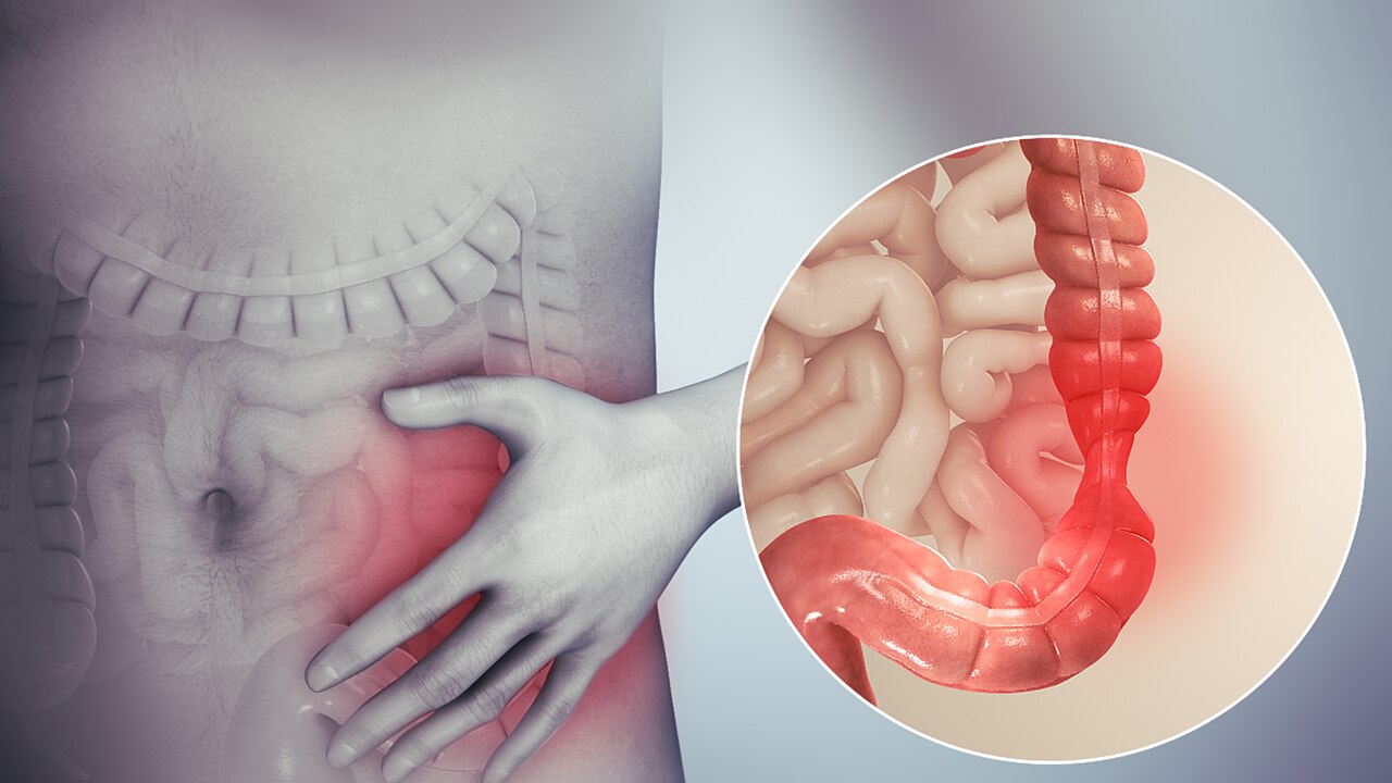 Illustration de l'intestin et du côlon pour comprendre le colon irritable